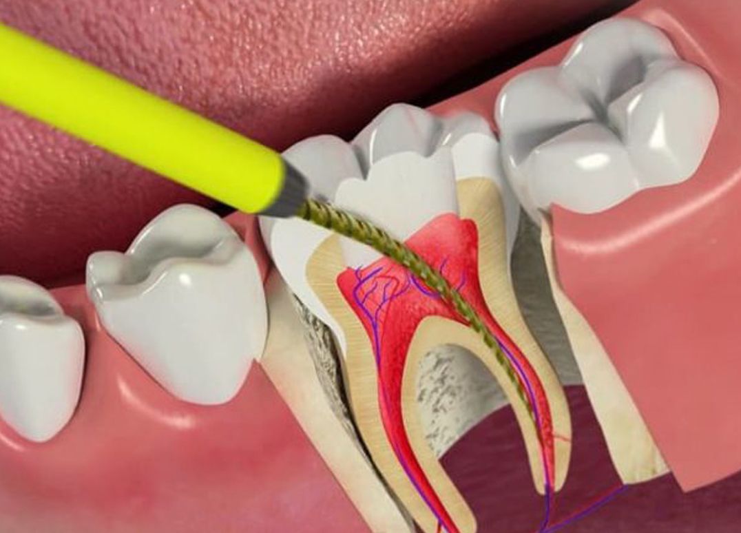 Лечение канала зуба